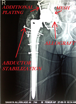 ALLOGRAFT TOTAL HIP REPLACEMENT (BONEBANK)