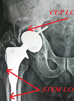 ALLOGRAFT TOTAL HIP REPLACEMENT (BONEBANK)