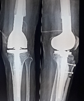 CUSTOM MADE HINGE KNEE REPLACEMENT