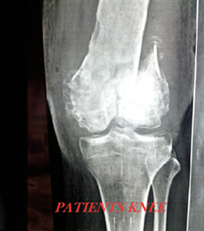 CUSTOM MADE HINGE KNEE REPLACEMENT